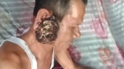 Ditengah Kemeriahan HUT Tubaba, Warga Tiyuh Penumangan Menderita Tumor Ganas Terkendala Biaya Berobat   